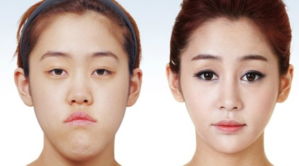 korean-plastic-surgery