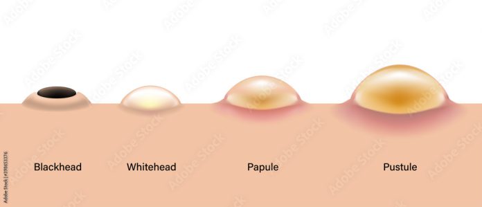 What Is A Pustule Skin Lesion 4nids