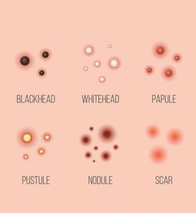 What is a Pustule Skin Lesion? - 4Nids