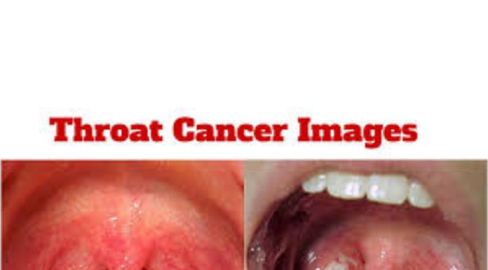 What Causes Throat Cancer Symptoms?