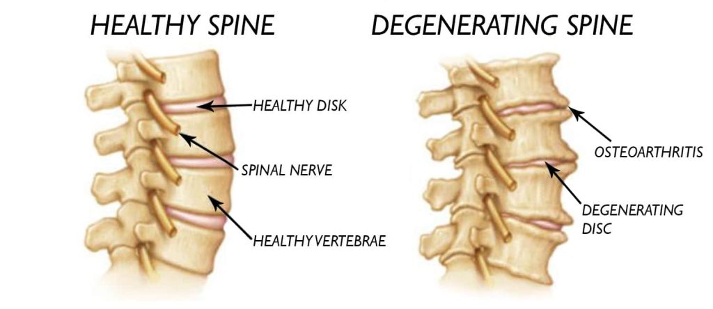 Spinal Disc Degeneration - Causes and Treatments - 4Nids