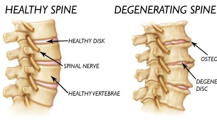 Spinal Disc Degeneration – Causes and Treatments