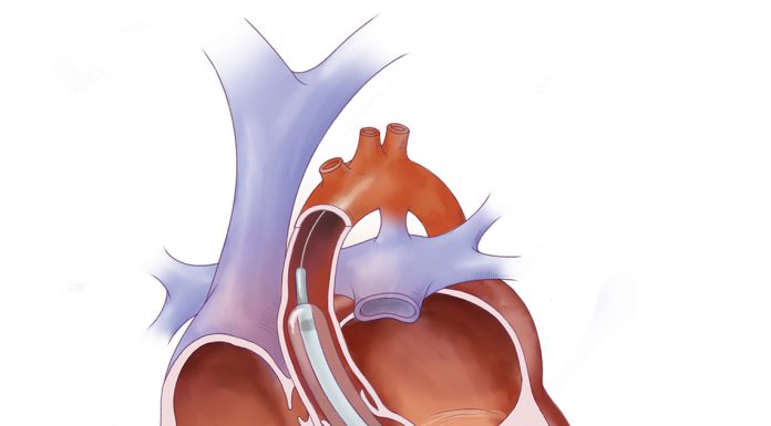Aortic Valvuloplasty Causes Treatments