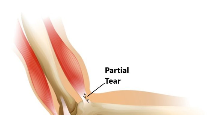 Bicep Tendon Elbow Anatomy