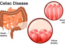 Non-Celiac Gluten Sensitivity Symptoms