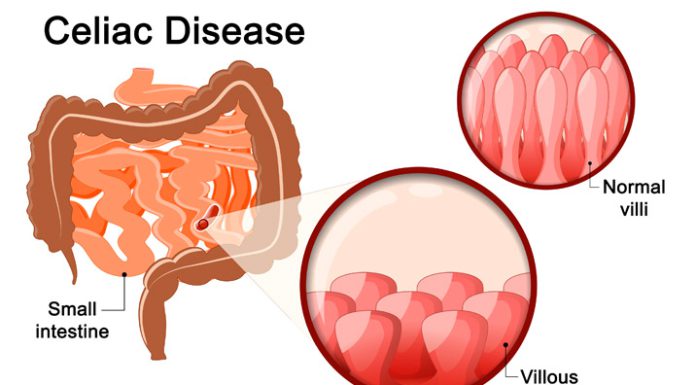 Non-Celiac Gluten Sensitivity Symptoms